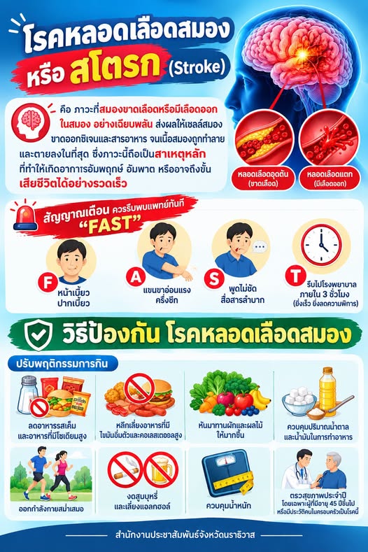   มาทำความเข้าใจกับ โรคหลอดเลือดสมอง หรือ สโตรก (Stroke) 